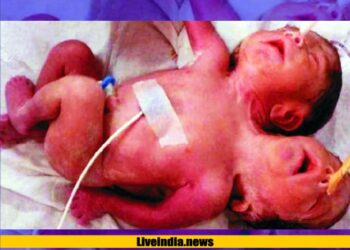 दो सिर, तीन हाथ वाली जुड़वा बच्चियों का जन्म