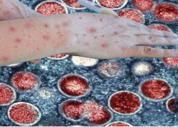 Pakistan African Country Mpox Vaccine Prevention Covid Pandemic